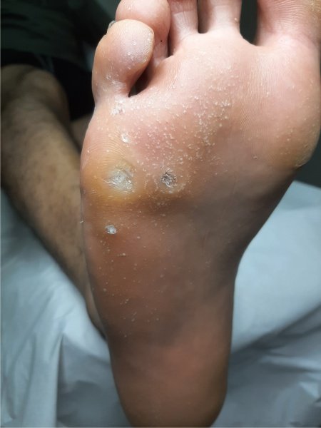 Pés com calosidades antes do tratamento